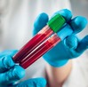 blood cancer, blood test, bone marrow, leukaemia, stem cells 